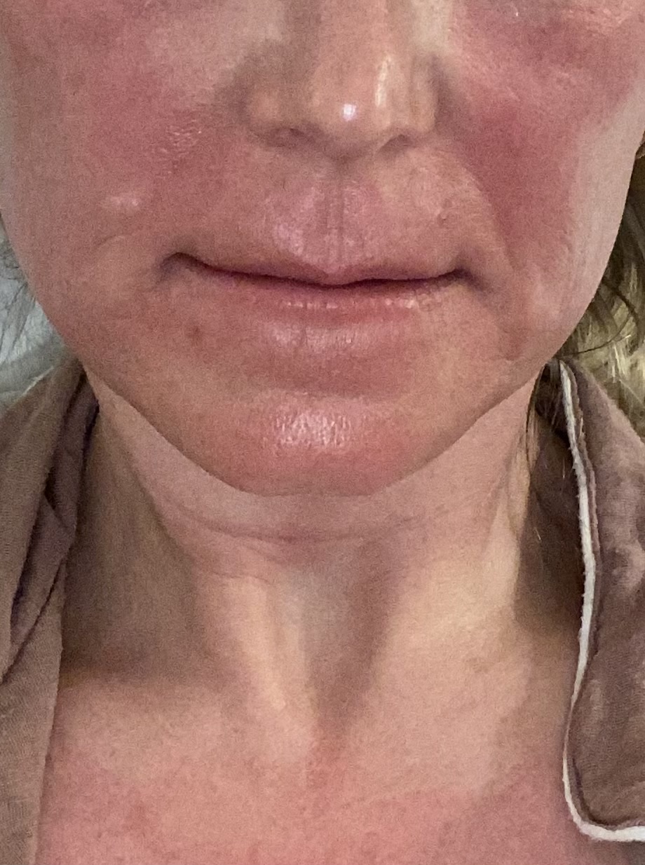 Microneedling Aftercare Guide